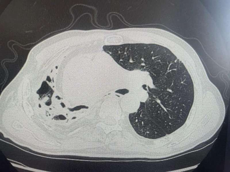 山林劳作藏隐患；七旬老人挖笋后肺损严重，专家详解防护之道。 健康养生